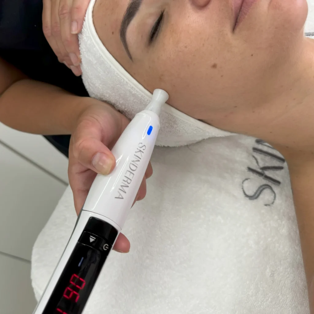 SKINCURE-PlasmaDermaTech-skinderma-1-scaled